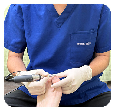 巻き爪の矯正風景